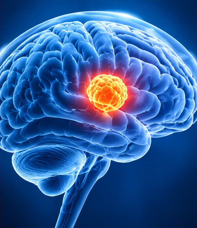 Brain tumor surgery illustration